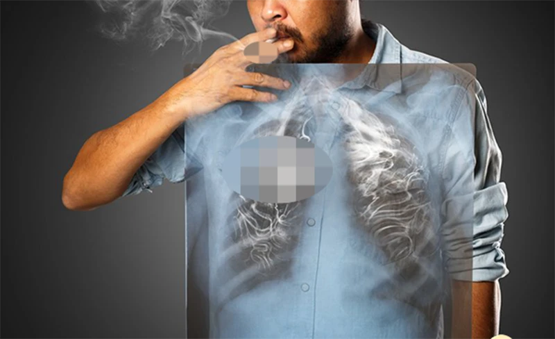 Có 64% người hút thuốc được chẩn đoán mắc bệnh ung thư vẫn tiếp tục hút thuốc
