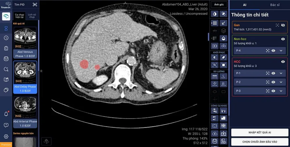 DrAid hỗ trợ tính năng tự động khoanh vùng và phân loại tổn thương gan ứng dụng trí tuệ nhân tạo, kết nối trực tiếp với phần mềm quản lý hình ảnh của bệnh viện (PACS)