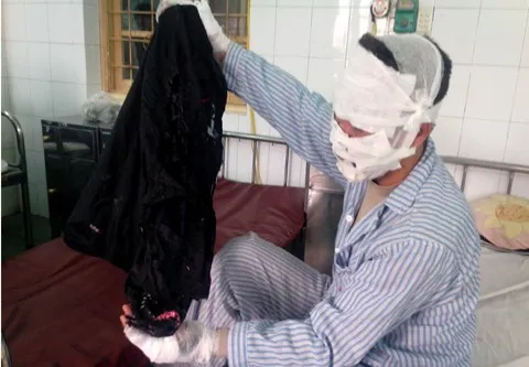 Anh Đ. bị bỏng kín mặt và 2 tay. Chiếc áo khoác anh mặc cũng bị cháy. Anh Đ. bị bỏng kín mặt và 2 tay. Chiếc áo khoác anh mặc cũng bị cháy.