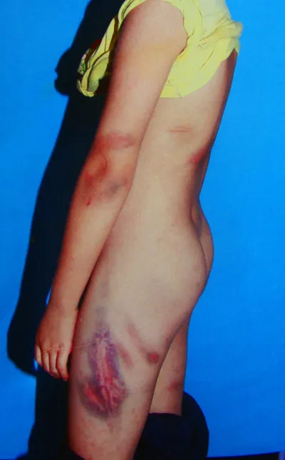 Cả làng đòi xử mẹ kế độc ác ảnh 2 Vết roi trên người cháu H.A.