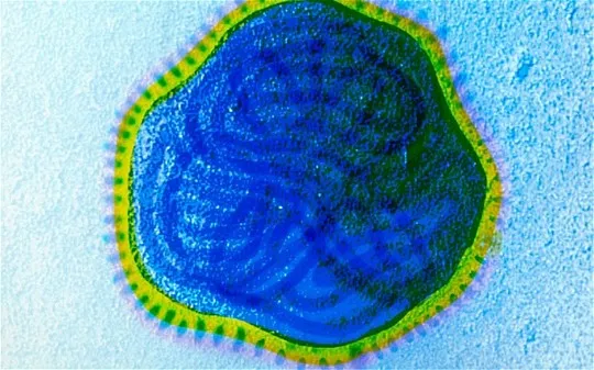 Trị ung thư bằng virus sởi ảnh 1 Khối u nhỏ dần lại và biến mất trong 36 giờ sau tiêm virus sởi