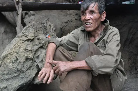 Ông Toán chỉ vào vết sẹo trong lần bị rắn cắn.