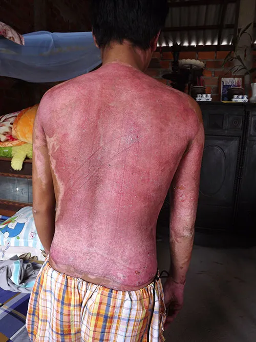 Vụ “Hóa chất gây hại dọc bờ biển Bến Tre”: Em Vũ đã được bồi thường ảnh 2 Vụ “Hóa chất gây hại dọc bờ biển Bến Tre”: Em Vũ đã được bồi thường ảnh 2