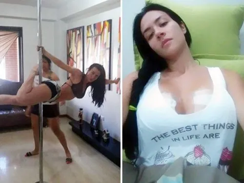 Diosa Canales. Cựu người mẫu Venezuela vỡ túi ngực khi múa cột