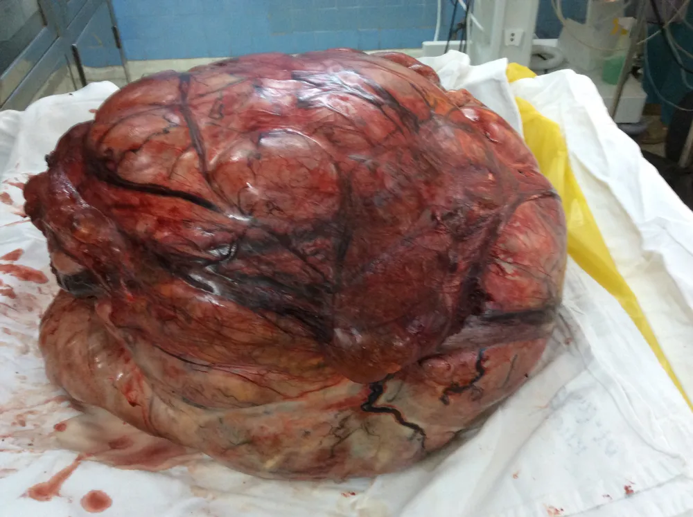 Cắt khối bướu tử cung nặng 26 kg ảnh 3 Cắt khối bướu tử cung nặng 26 kg ảnh 3