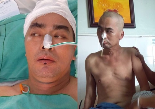 nguyen-hoang-cu-dong-duoc-tay-phai-sau-hon-mot-thang-mo-nao