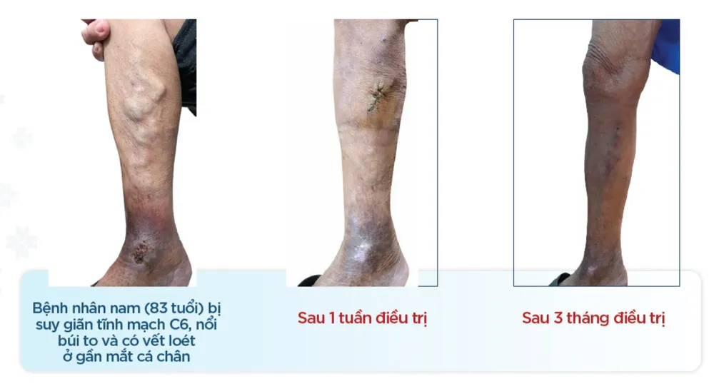 Bernard Healthcare điều trị thành công ca suy giãn tĩnh mạch lâu năm gây biến chứng loét không lành. Bernard Healthcare điều trị thành công ca suy giãn tĩnh mạch lâu năm gây biến chứng loét không lành.png