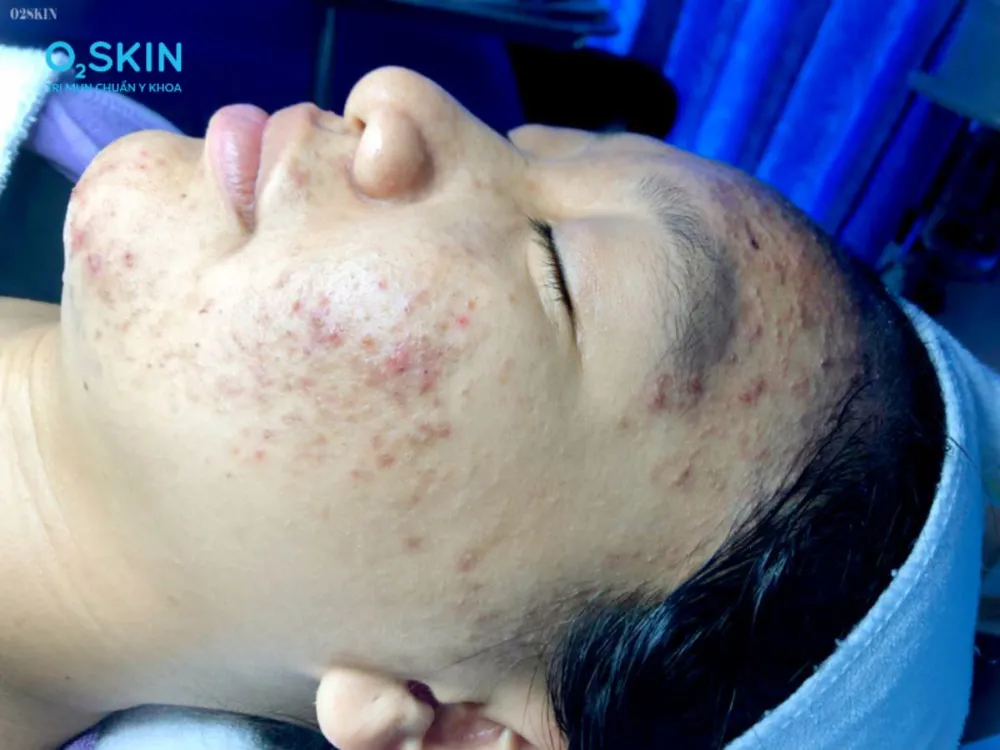 Trong suốt hơn 8 năm bị mụn, Quỳnh Anh thường xuyên rơi vào trạng thái suy sụp tinh thần. Kiên trì với phác đồ điều trị mụn trứng cá, nữ sinh nhận 'trái ngọt' sau 3 tháng.png