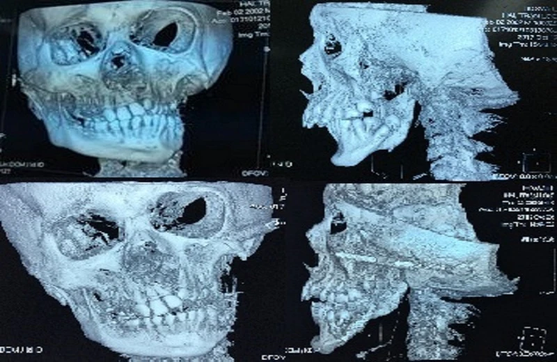 Trả lại gương mặt bình thường cho trẻ bị tật ảnh 2