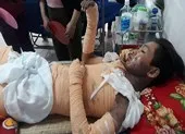 Bỏng nặng do điện giật, một người nhập viện nguy kịch