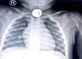 Mảnh xương hình khối nằm trong phế quản bệnh nhân suốt 5 năm ảnh 2 Trẻ tắc ống thực quản vì nuốt mặt dây chuyền