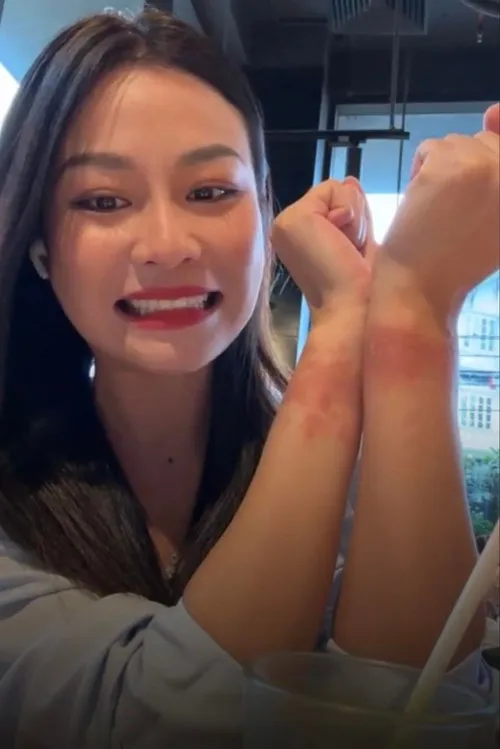 Quỳnh Châu &quot;khoe&quot; vết bầm trên sóng livestream khi tham gia quay phim. Ảnh: Chụp màn hình