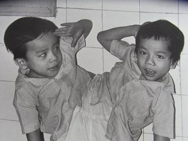Cặp song sinh Việt - Đức trước khi mổ tách rời. Ảnh: Tư liệu cap-song-sinh-viet-duc_fkxf.jpg.jpg