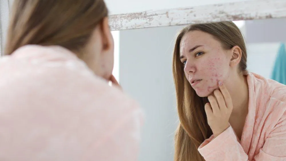 uong-tra-sua-gay-noi-mun uong-tra-sua-gay-noi-mun