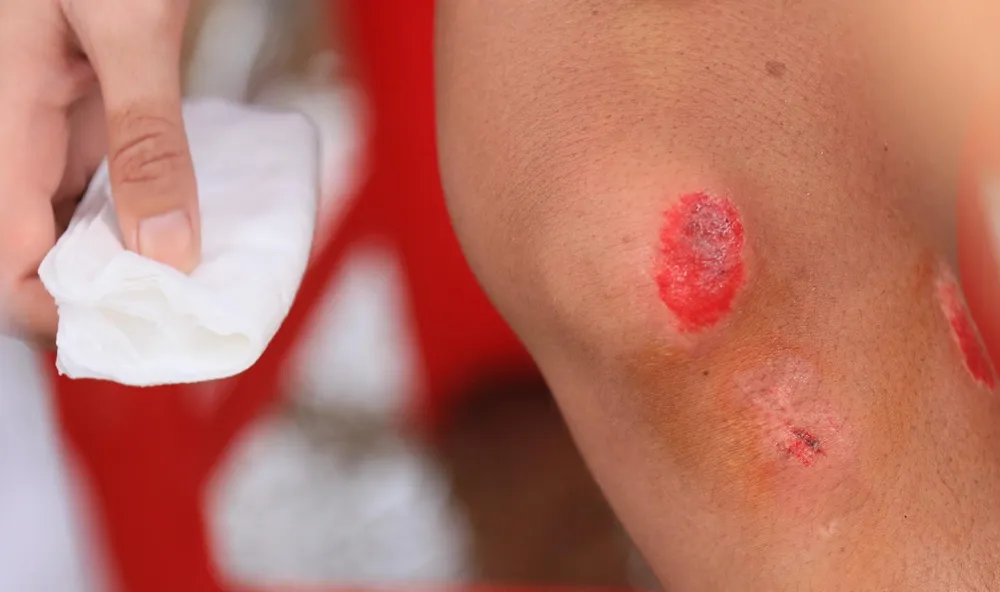 ...vết thương của Nguyễn Thị Thi sau sự cố té ngã do đường trơn vì trời mưa.