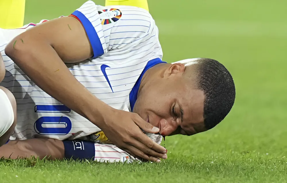 Mbappe bị gãy mũi ở trận gặp Áo. Ảnh: GETTY siêu sao Mbappe