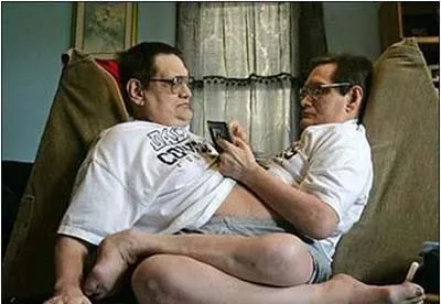 Những cặp song sinh dính liền vẫn sống tốt ảnh 3