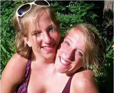 Những cặp song sinh dính liền vẫn sống tốt ảnh 5