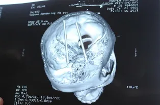 Cấp cứu bệnh nhân bị 2 chiếc đũa đâm xuyên não ảnh 1