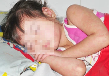 Coi chừng bùng phát dịch sởi ảnh 1