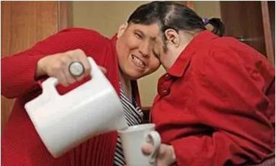 Những cặp song sinh dính liền vẫn sống tốt ảnh 6