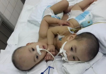 Ca phẩu thuật tách rời cặp song sinh ảnh 1