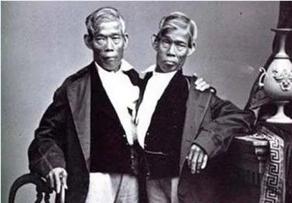 Những cặp song sinh dính liền vẫn sống tốt ảnh 4