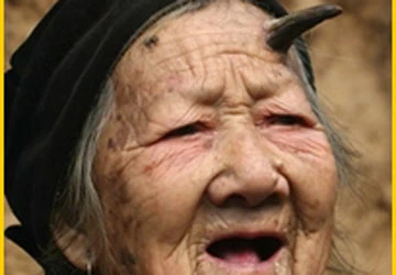 Cụ bà 101 tuổi tại Trung Quốc bất ngờ mọc sừng ảnh 1