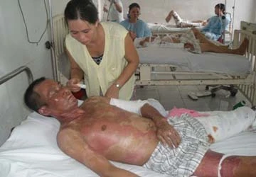 Mù mắt, bỏng nặng vì sử dụng bếp cồn ảnh 1