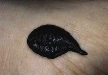 Những phương pháp chữa bệnh ghê rợn nhất lịch sử ảnh 2