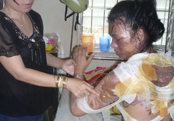 Chồng tạt nước sôi, vợ bị bỏng nặng ảnh 1