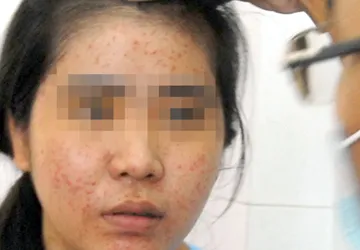 Tẩy trắng siêu tốc thành... siêu mụn ảnh 1 Tẩy trắng siêu tốc thành... siêu mụn ảnh 1