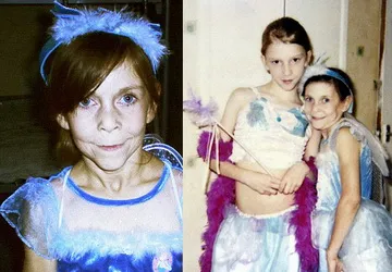 Phẫu thuật cho bé gái 16 tuổi mang gương mặt bà cụ ảnh 1 Phẫu thuật cho bé gái 16 tuổi mang gương mặt bà cụ ảnh 1