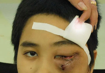 Bệnh nhi bị u mạch máu xương hiếm gặp ảnh 1