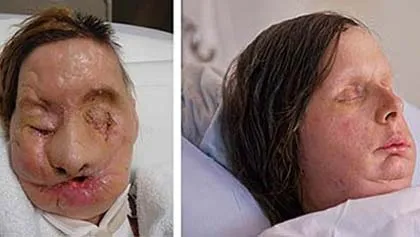 Chuyện của người đàn bà bị tinh tinh xé nát mặt ảnh 2 Chuyện của người đàn bà bị tinh tinh xé nát mặt ảnh 2