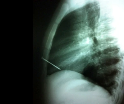 Vẫn sống dù bị đinh dài 8cm đâm vào tim ảnh 1