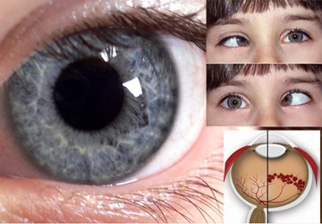 Cần phát hiện sớm những trẻ mắt mèo ảnh 1