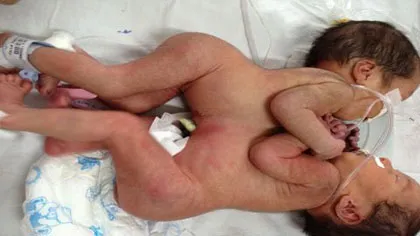 Cặp song sinh dính nhau và kỳ tích 24 năm trước ảnh 1