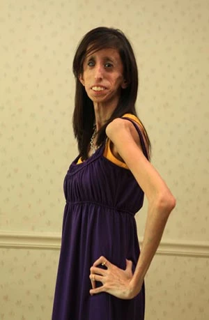 Cô gái "xấu xí nhất thế giới" mơ làm diễn giả ảnh 1