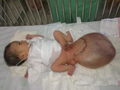 Bé trai chào đời với khối u quái to hơn cơ thể ảnh 1