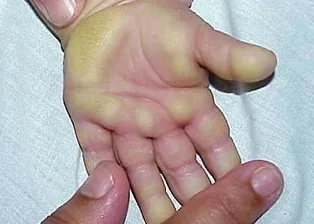 Gần 50 người bị bệnh "lạ" gây tổn thương da, suy thận ảnh 1