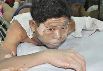 Nổ ở xưởng gỗ, 21 người bỏng nặng ảnh 2 Nổ ở xưởng gỗ, 21 người bỏng nặng ảnh 2