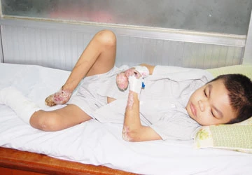 Bệnh “rụng ngón chân, ngón tay” ảnh 1