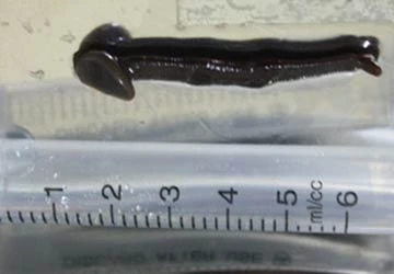 Đỉa sống trong khí quản ảnh 1 Đỉa sống trong khí quản ảnh 1