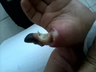 Bé trai bị cắt cụt ngón cái vì phỏng điện ảnh 1