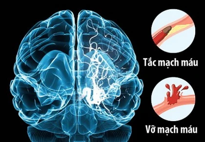 Mất ngủ kèm stress dễ dẫn đến suy kiệt ảnh 1