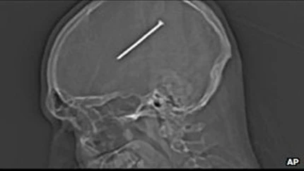 Sống sót sau khi bị đinh 8cm ghim vào não ảnh 1