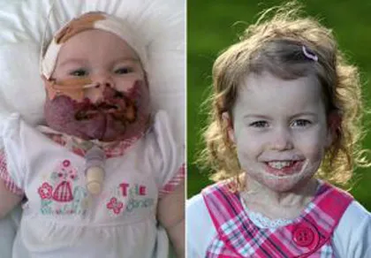 Phương thuốc thần kỳ “cứu” khuôn mặt bé gái ảnh 1