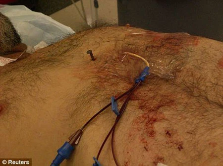 Đinh 10cm cắm vào tim, vẫn sống sót kỳ diệu ảnh 2 Đinh 10cm cắm vào tim, vẫn sống sót kỳ diệu ảnh 2