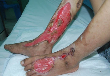 Nguy cơ lờn thuốc do lạm dụng kháng sinh ảnh 1